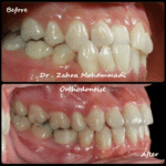 نمونه درمان ارتودنسی ثابت دو فک در ۲۴ سالگی – اصلاح کراس بایت یکطرفه