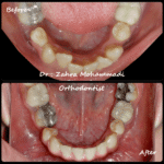 نمونه درمان ارتودنسی ثابت دو فک در ۲۴ سالگی – اصلاح کراس بایت یکطرفه